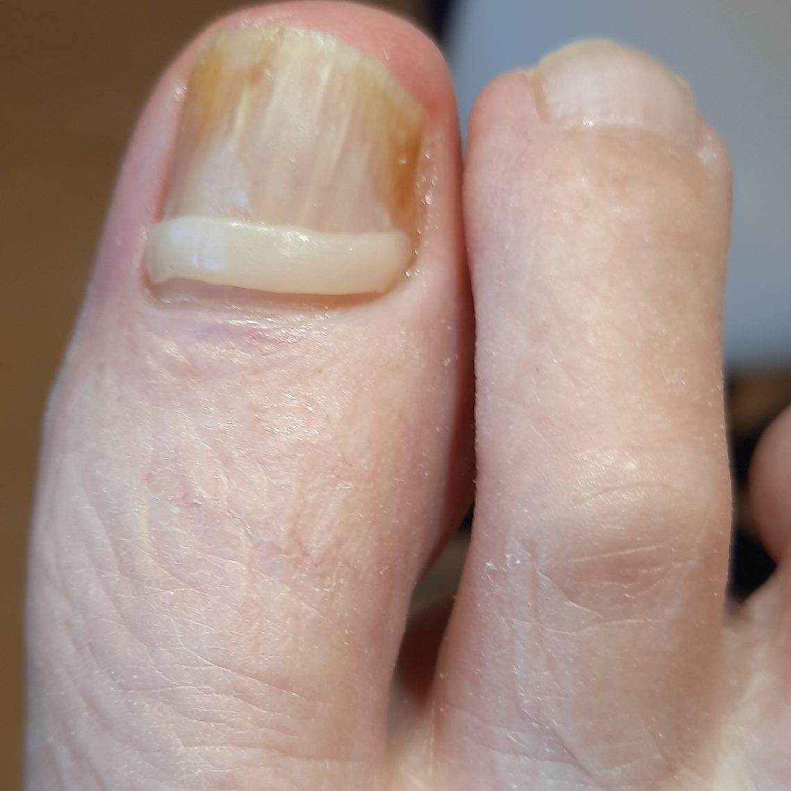 Uni Brace nagelbeugel Medisch Pedicurepraktijk De Ruiter